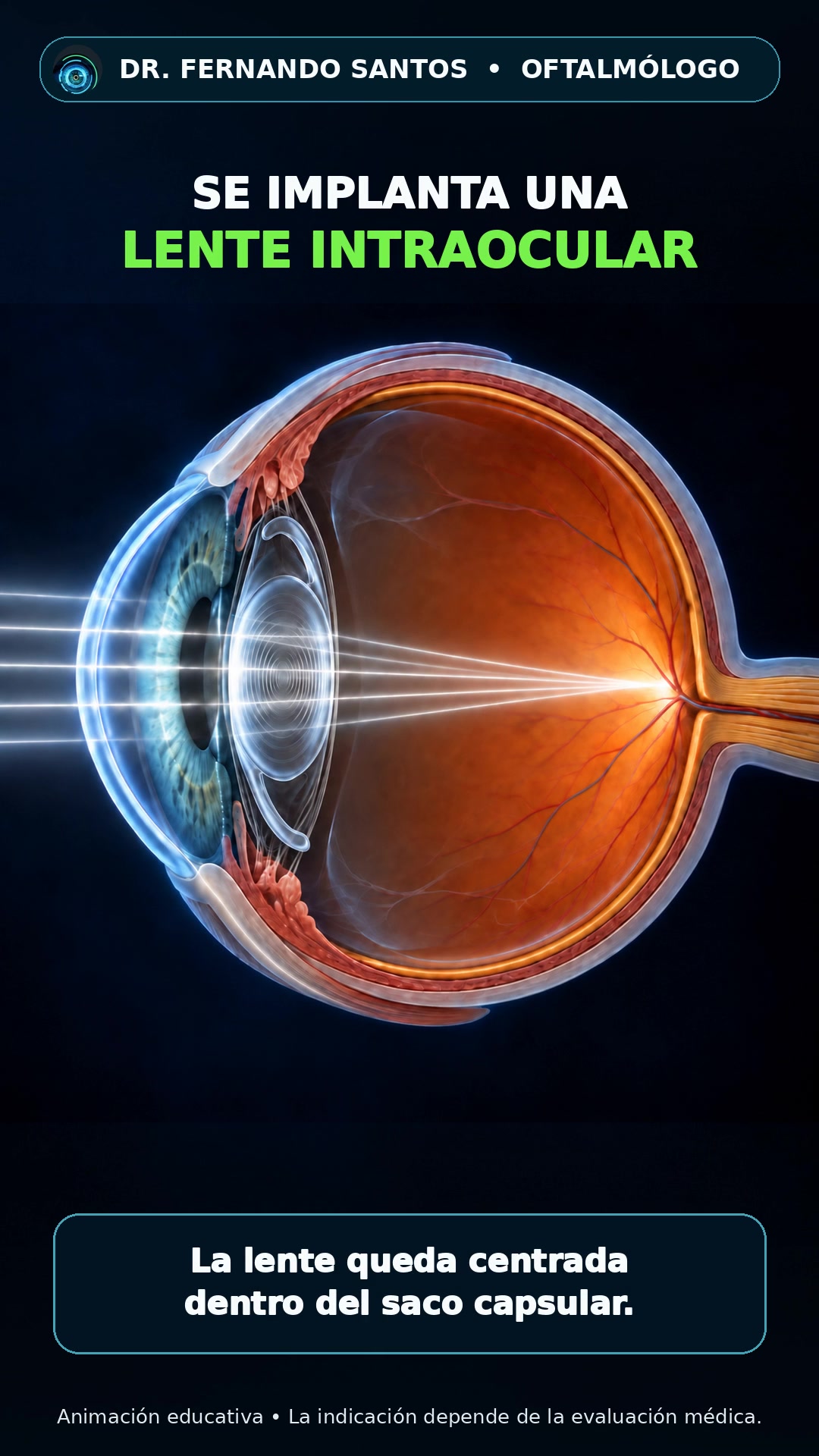 Corte lateral del ojo con un lente intraocular
